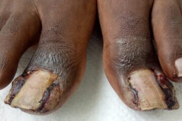 Ingrown toe nails
